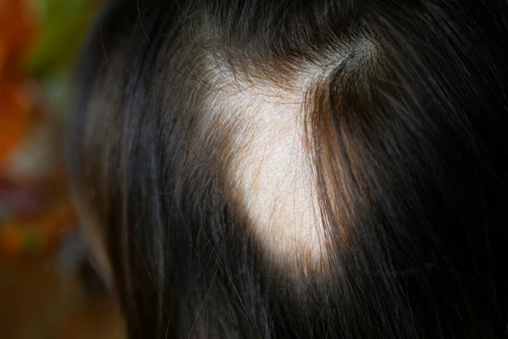 Cabello de un paciente con una placa de alopecia areata.