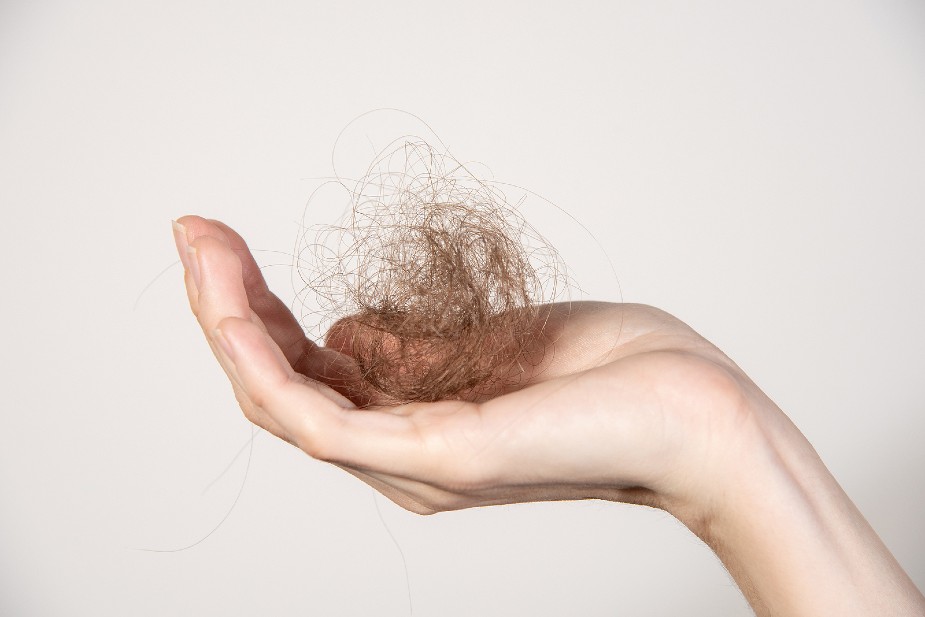 Mujer sujetando en la mano cabellos sueltos desprendidos de la cabeza. El lupus provoca alopecia temporal o crónica