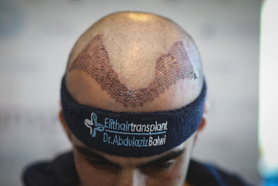 Paciente de Elithairtransplant con cinta en la cabeza para prevenir la hinchazón después del injerto capilar