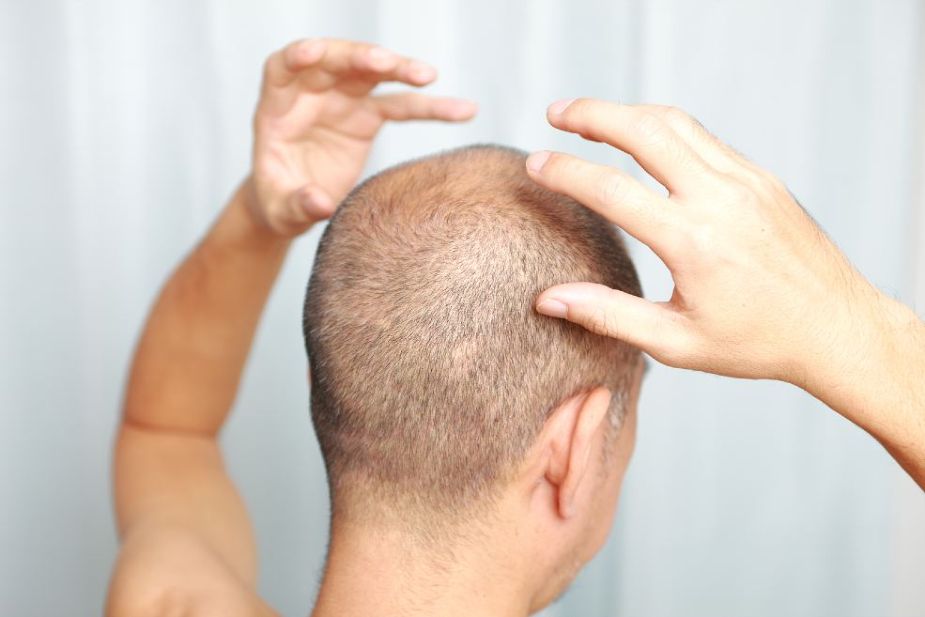 Hombre con caída del cabello cubriéndose con las manos la cabeza.