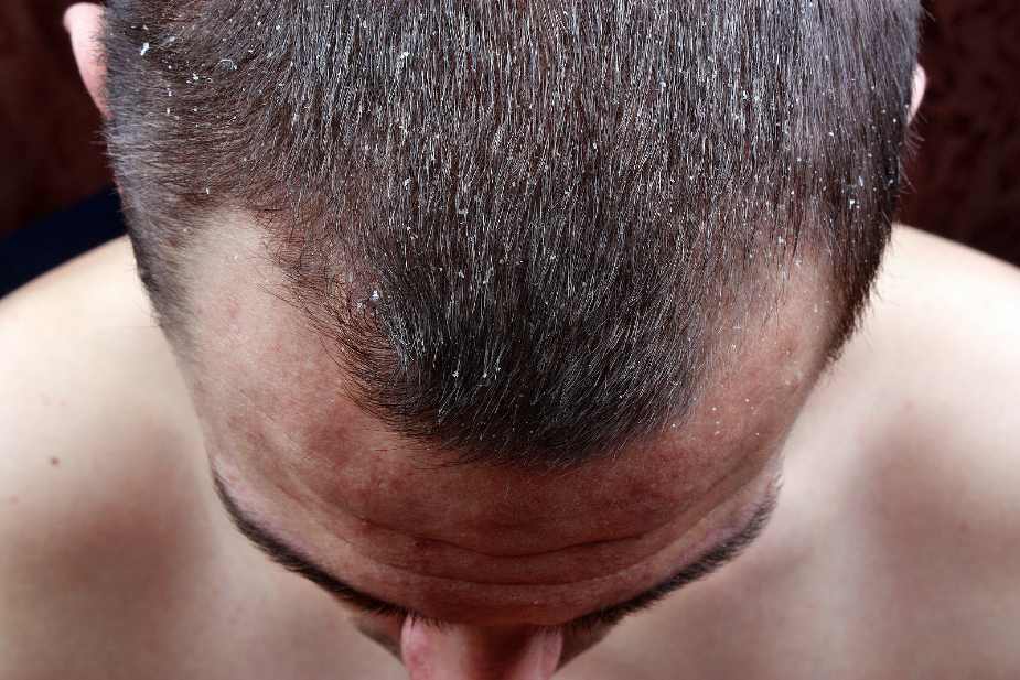 La caspa es un síntoma de dermatitis seborreica en el pelo.