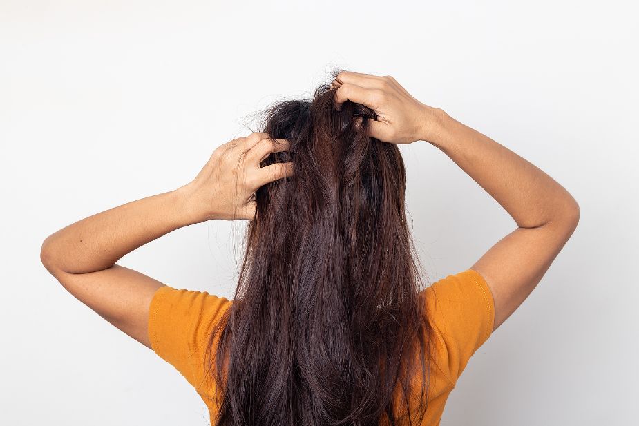 Mujer con problemas de caspa rascándose el cabello