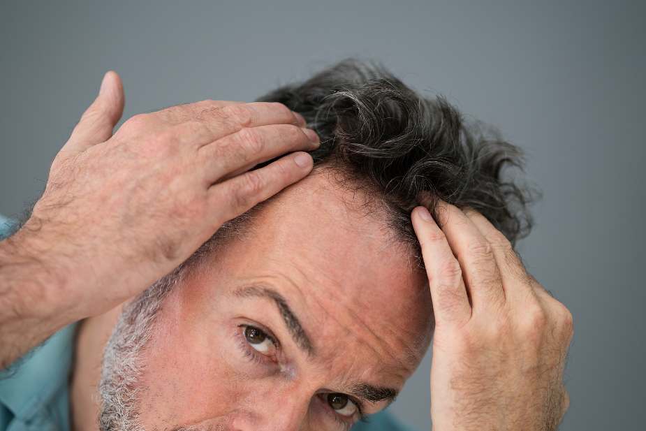 Hombre comprobando si presenta una caída excesiva del cabello en la frente.