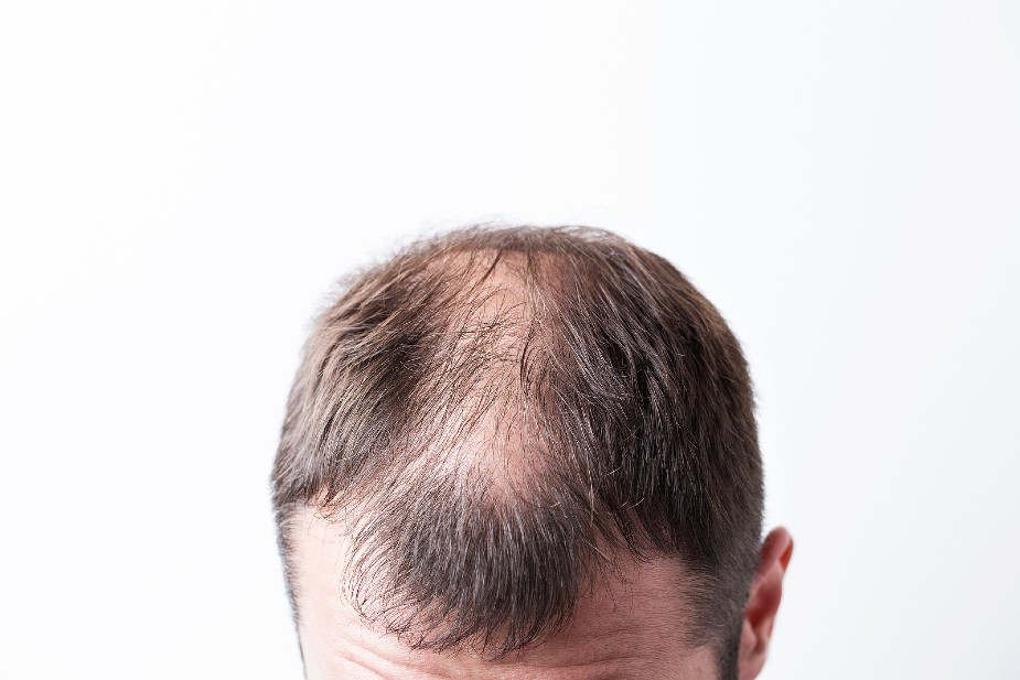 Hombre con cabello escaso en la zona superior de la cabeza.