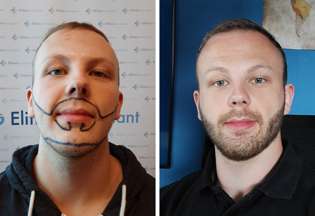 Imagen del antes y después del implante de barba con 3250 folículos de Sascha L.