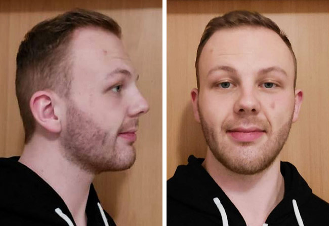 Imagen 1 mes después del implante de barba con 3250 folículos de Sascha L.