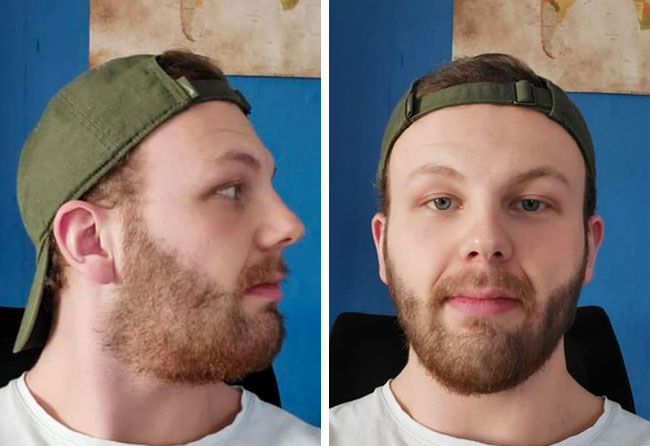Resultado final del implante de barba con 3250 folículos de Sascha L.