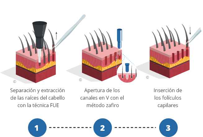 infografía que muestra el proceso de un injerto capilar FUE Zafiro