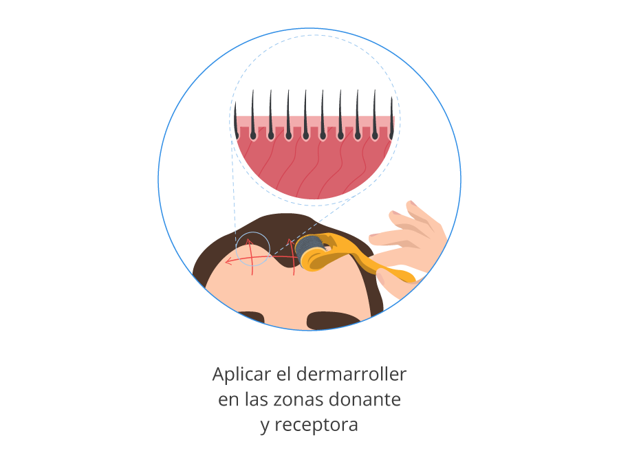 Imagen gráfica de la aplicación del dermarroller en las zonas donante y receptora de un injerto capilar