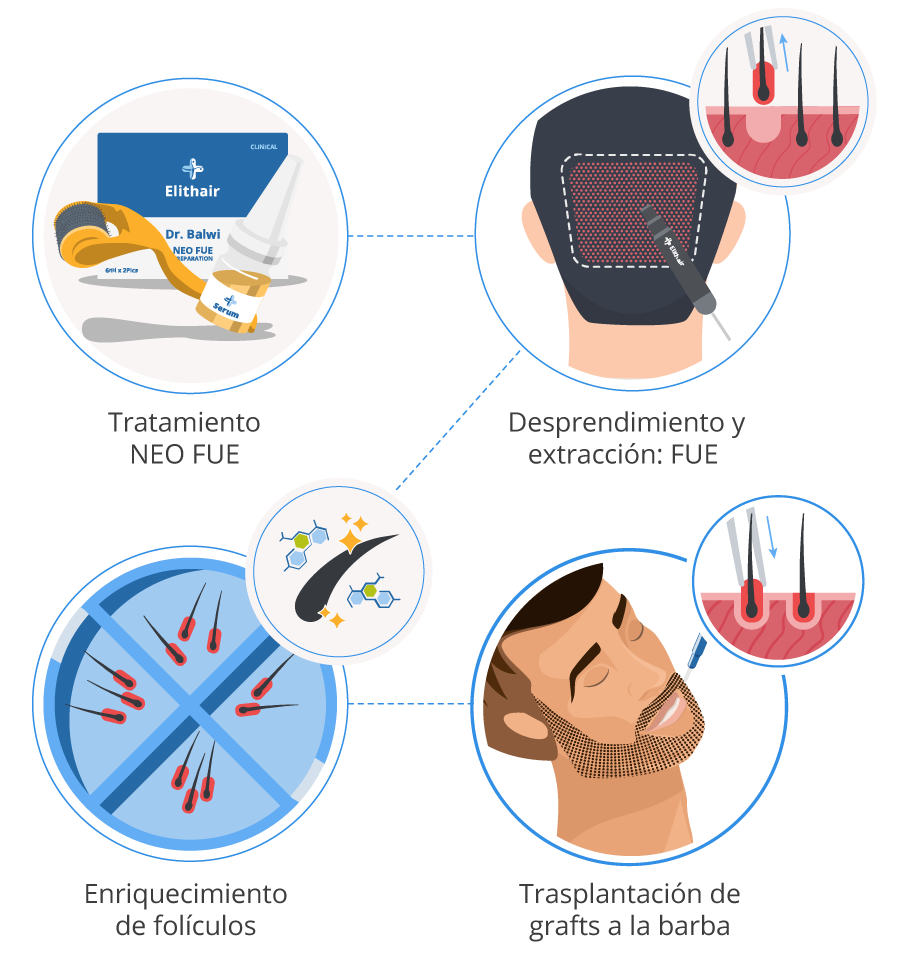 Imagen gráfica de los 4 pasos del implante capilar de barba