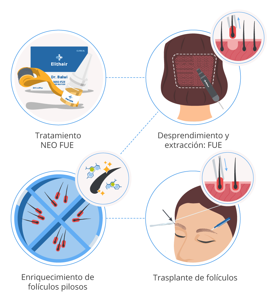 Imagen gráfica de los 4 pasos del procedimiento de un implante de cejas