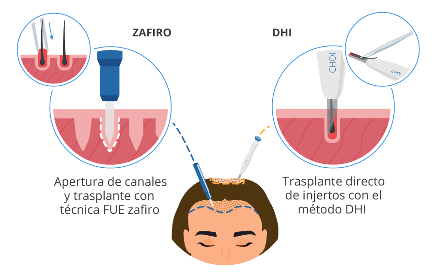 Imagen gráfica del proceso de trasplante de grafts en mujer con las técnicas FUE Zafiro y DHI