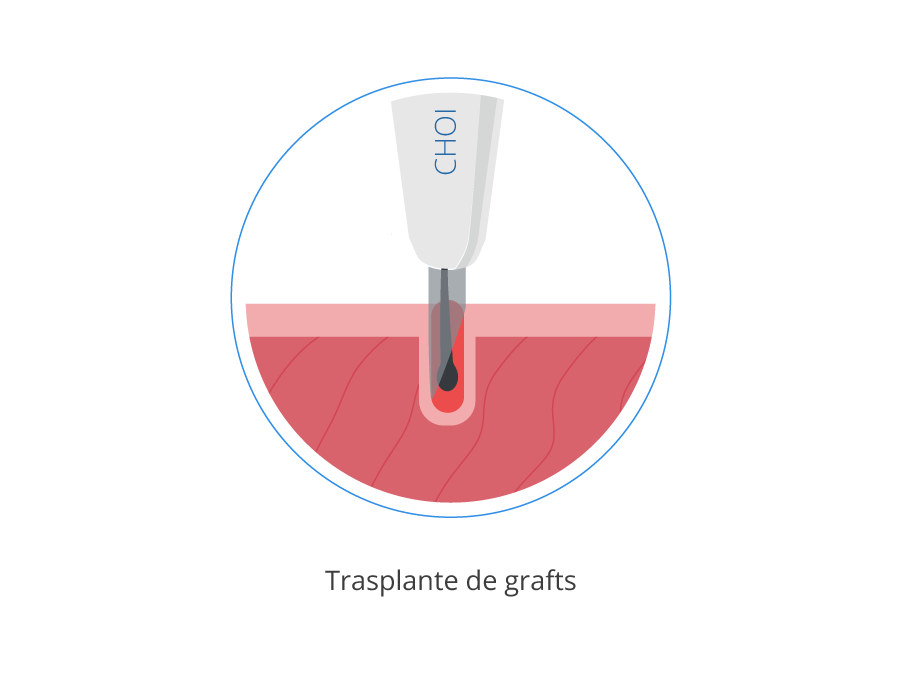 Imágen gráfica del transplante e implantación de grafts con el CHOI-Pen de la técnica DHI de injerto capilar