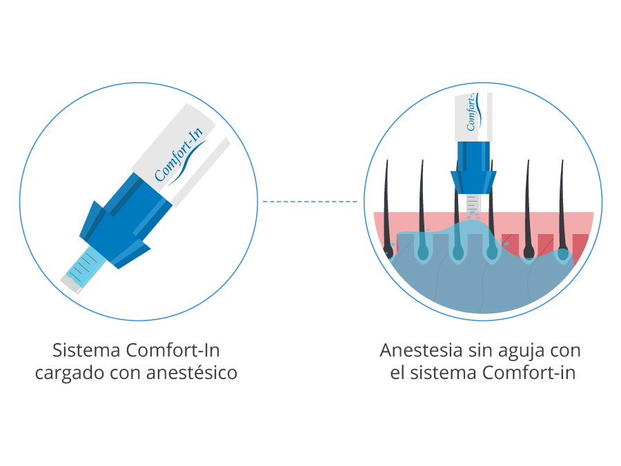 Infográfica de la utilización del sistema Comfort-In para la anestesia sin agujas en un trasplante capilar