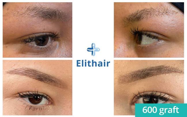 Antes y después de un implante de cejas de Liliana