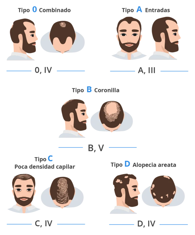 Infográfica Elit-skala sobre la clasificación de los tipos de pérdida de cabello