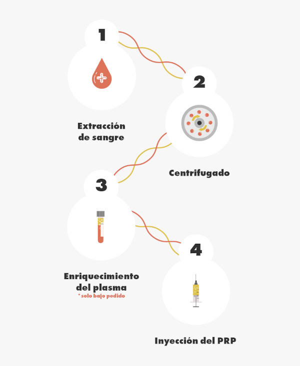 alt="Infografía explicativa del proceso de extracción del plasma rico en plaquetas para el tratamiento PRP de injerto capilar"