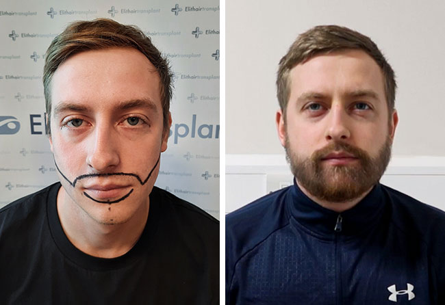 Comparativa antes y después del implante de barba con 4200 grafts de Jay J.