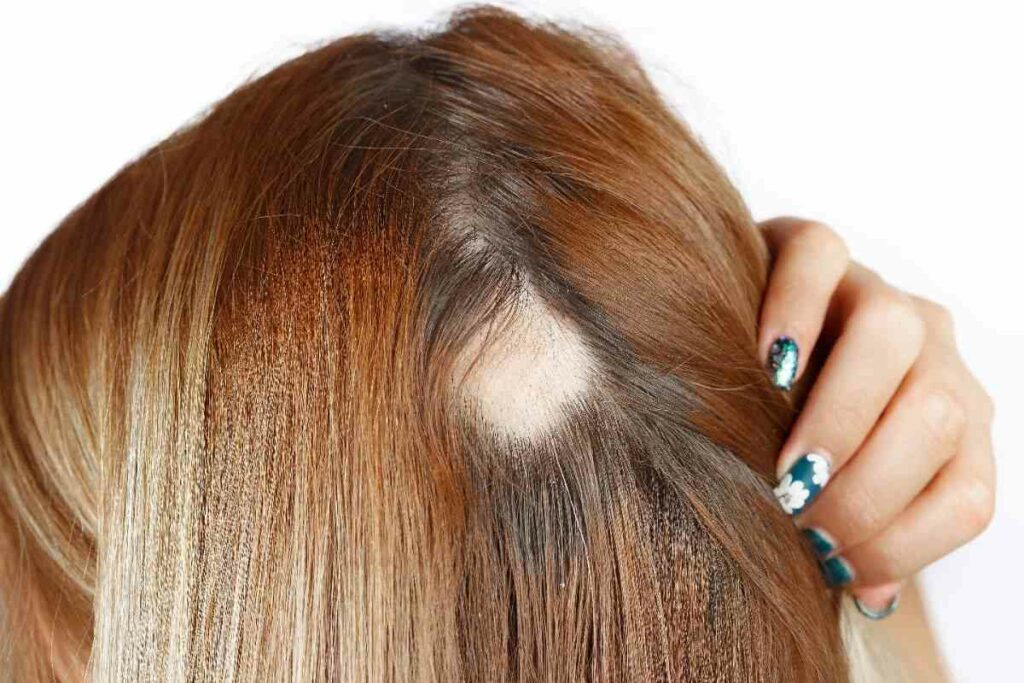 Detalle de alopecia areata en mujeres