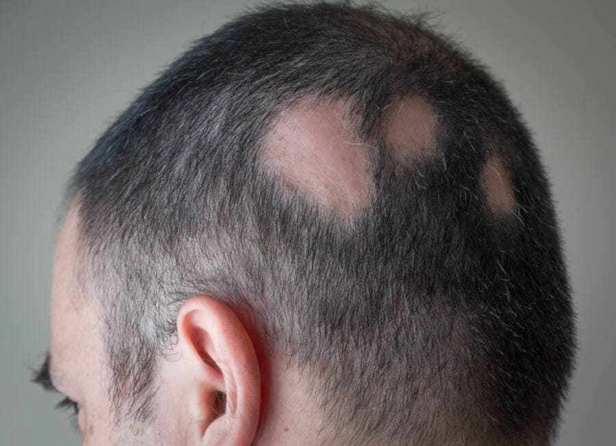 Alt text: Hombre con huecos en la cabeza a causa de la alopecia areata.