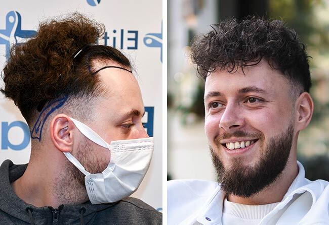 Antes y después del trasplante de pelo DHI con 3140 injertos del paciente Cilian W.