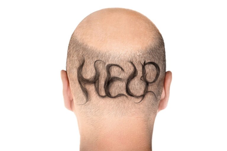 Imagen de un hombre con alopecia con el pelo cortado con la palabra "Help" en la nuca