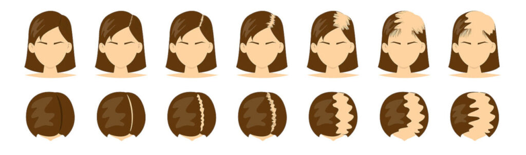 Diferentes grados de alopecia con patrón femenino.