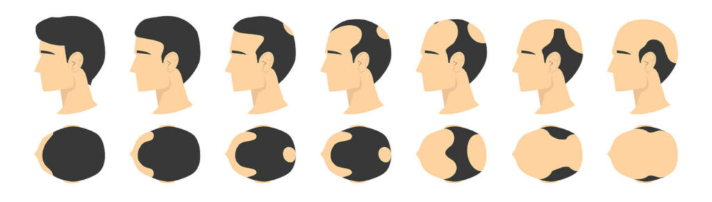 Escala Norwood con las diferentes fases de la alopecia androgénica masculina.