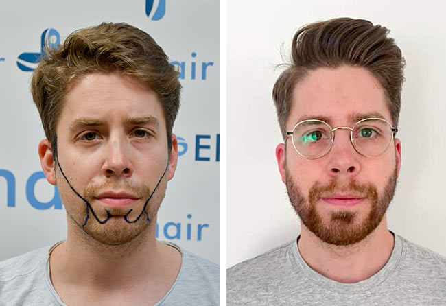 Antes y después del trasplante de barba de 3200 injertos con el método zafiro de Eike R.