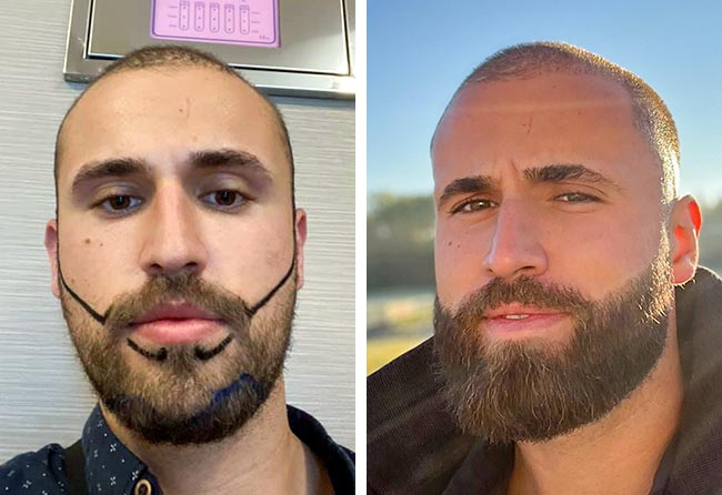 Antes y después del implante de barba con el método zafiro de 3300 injertos de Hu Le.