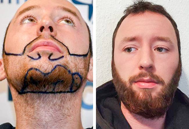 Antes y después del implante de barba con el método zafiro de 3700 injertos de Felix V.