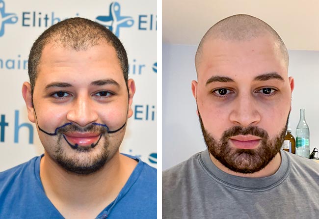 Antes y después del implante de barba con el método zafiro de 3750 injertos de Mohammed E.