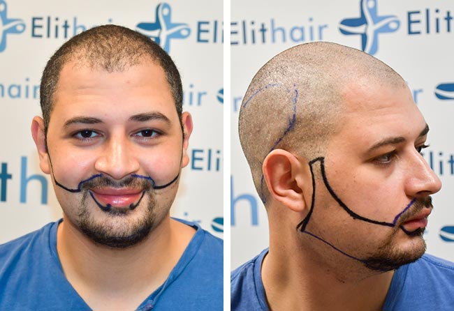 Antes del implante de barba con el método zafiro de 3750 injertos de Mohammed E.