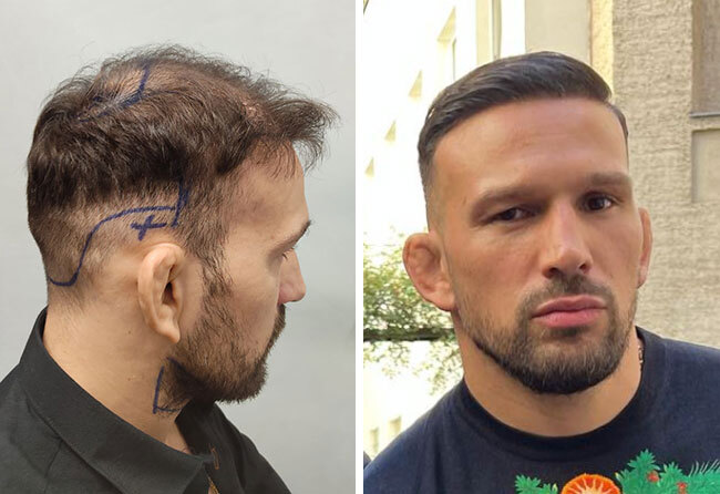Fotos del antes y después del trasplante de pelo DHI con 3250 injertos de Max Coga.