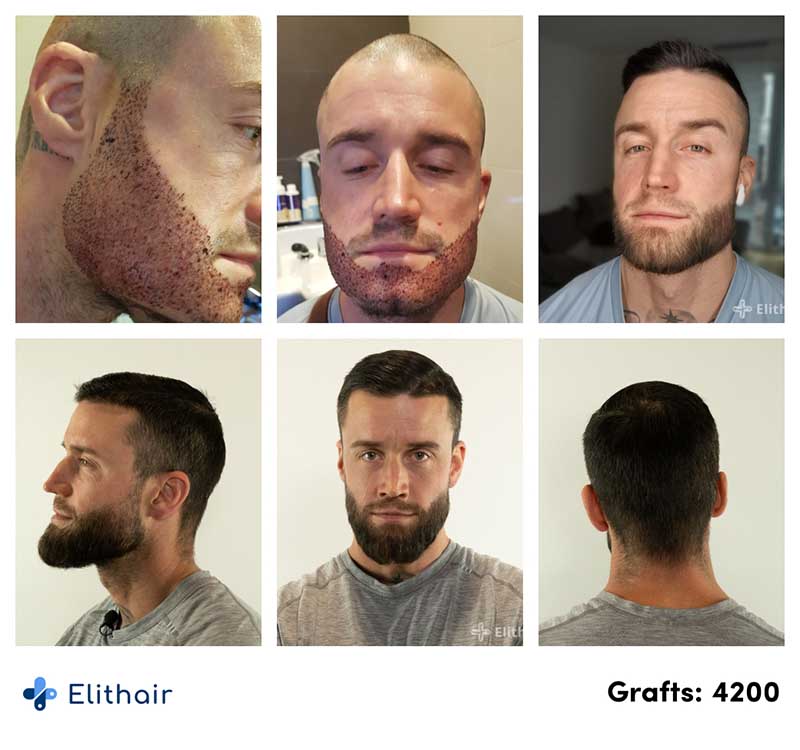Imágenes del antes y después de un implante de barba de 4200 injertos en Elithair.