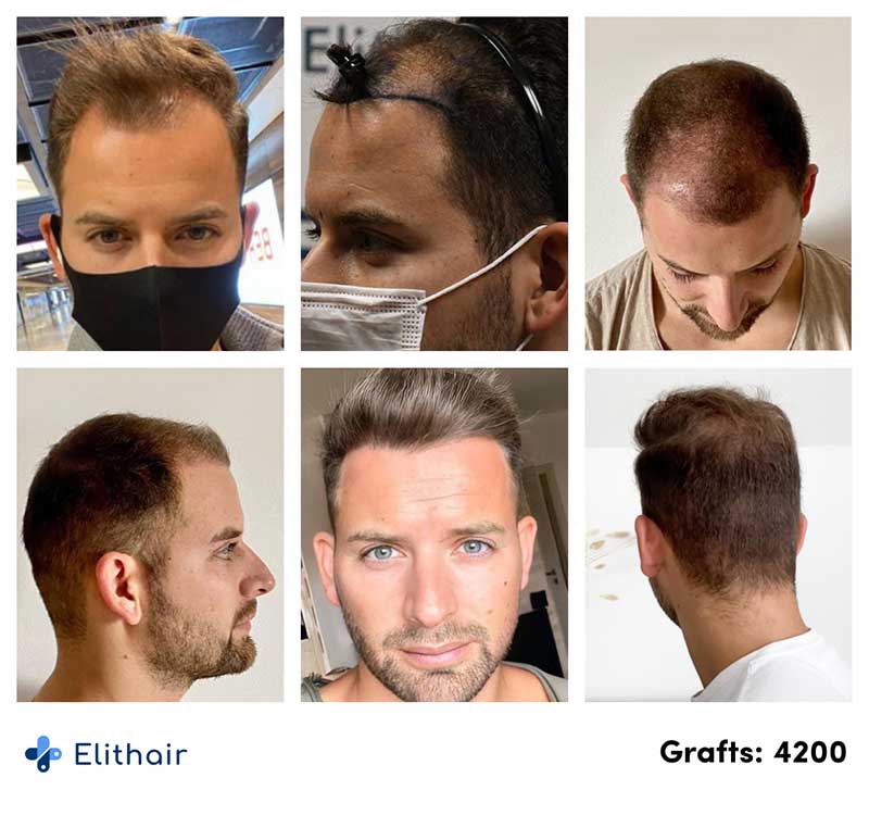 Imágenes del antes y después del trasplante capilar percutáneo de 4200 injertos de Marcel O.