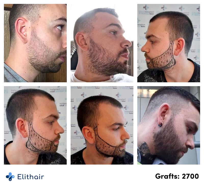 Fotos del antes y después de un trasplante de barba de 2700 injertos en Elithair.