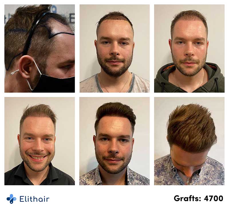 Fotos del antes y después de un trasplante capilar DHI de 4700 injertos de nuestro paciente Michael en Elithair.