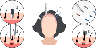 Imagen gráfica del proceso de implantación de folículos en una mujer con el método SDHI (técnicas FUE Zafiro y DHI).
