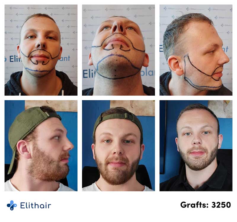 Fotos del antes y después de un implante de barba de 3250 injertos en Elithair.