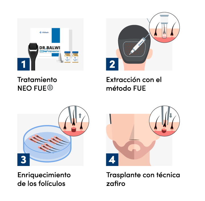Imagen gráfica del procedimiento de un implante capilar de barba en Elithair.