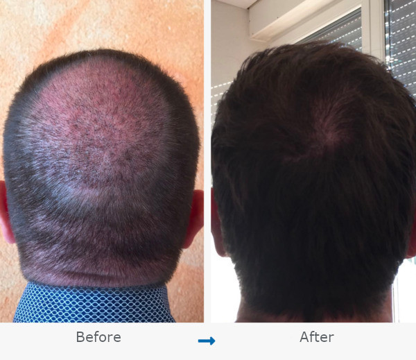 A before and after image of a hair transplant at the crown area