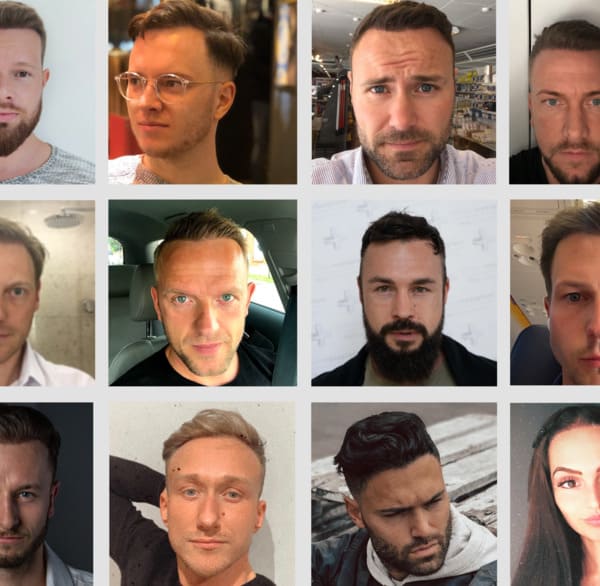 A gallery of hair transplant pictures before and after