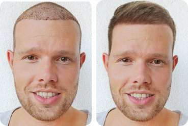 A hair transplant before the results have begun to show
