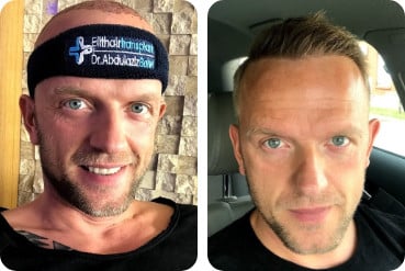 A hair transplant to fill a high forehead