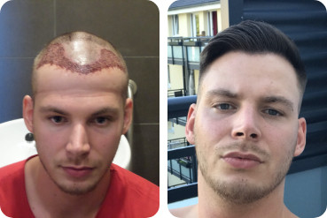 A hair transplant to fill a receding hairline