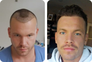 A hair transplant to repair a receding hairline