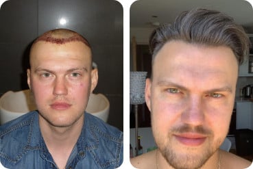 A patient straight after having a hair transplant