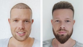 Beard transplant before and after