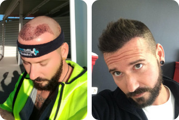 Before the results of a hair transplant on the front hair line